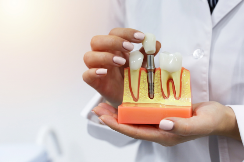 השתלות חדישות - האפליקציה המתקדמת שמרכזת את כל המידע על השיטות החדישות להשתלות שיניים